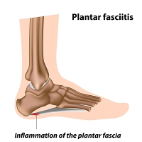 How Is Plantar Fasciitis Diagnosed?