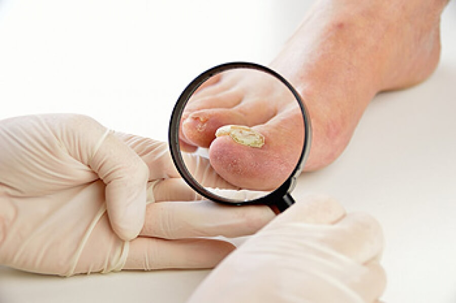 Vinegar on nail on sale fungus