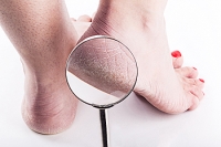 Common Causes of Cracked Heels