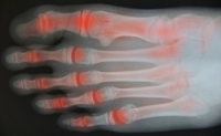 Arthritis Can Be Found in the Toes