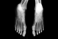 Understanding Foot Stress Fractures