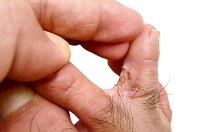 What Symptoms Are Indicative of Athlete’s Foot?
