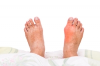 Gout Can Cause Pain and Discomfort