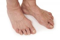Symptoms of Arthritis in the Feet
